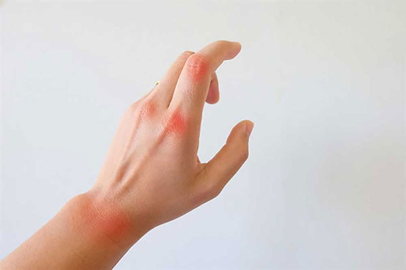 Triệu chứng của viêm khớp
