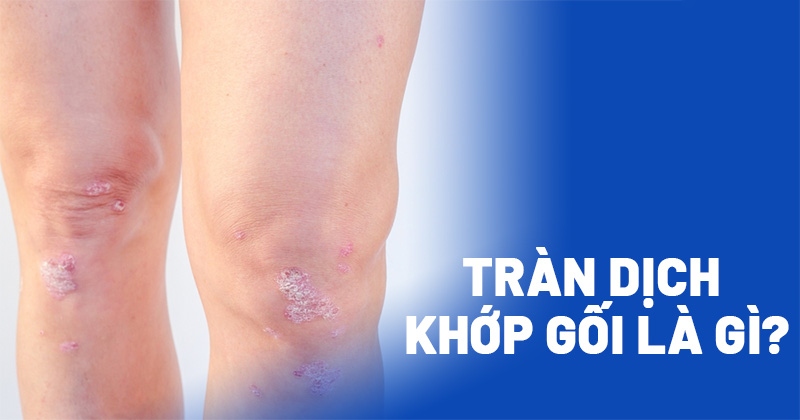 Tràn dịch khớp gối: Nguyên nhân, dấu hiệu và cách cải thiện
