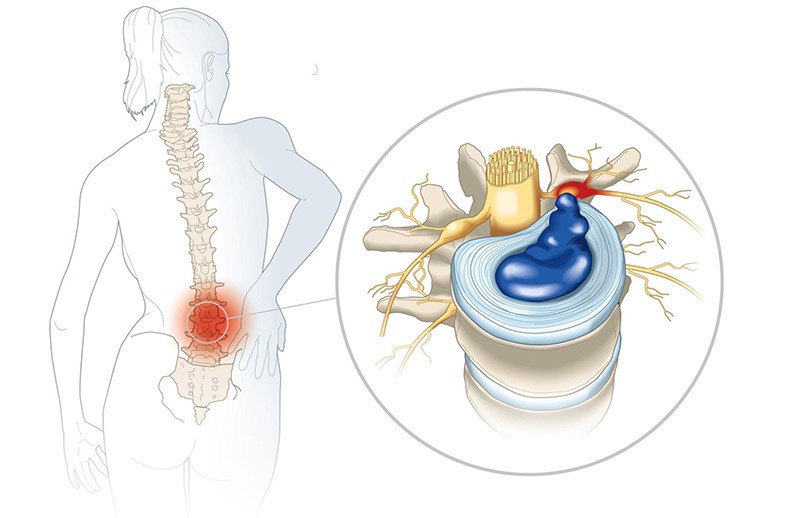 Đĩa đệm rời khỏi vị trí