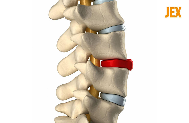 Thoát vị đĩa đệm là một trong những nguyên nhân phổ biến gây đau cột sống lưng