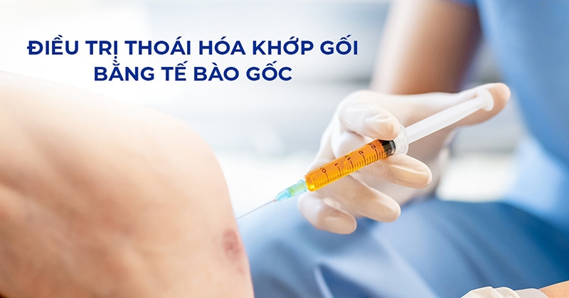 Điều trị thoái hóa khớp gối bằng tế bào gốc là gì? Khi nào nên sử dụng?