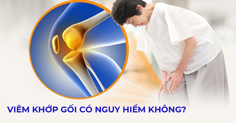 Viêm khớp gối có nguy hiểm không? Đối tượng dễ có nguy cơ mắc bệnh