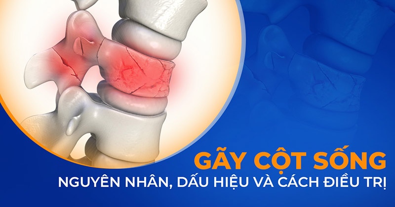 Gãy cột sống (Gãy xương sống): Nguyên nhân, dấu hiệu và điều trị