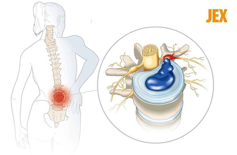 Biến chứng đĩa đệm mất nước