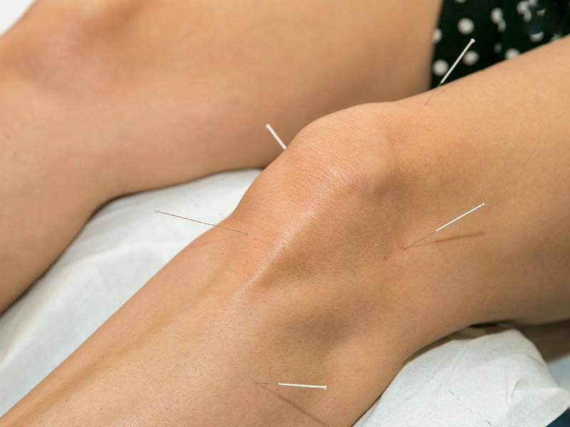 Phương pháp châm cứu thoát hóa khớp