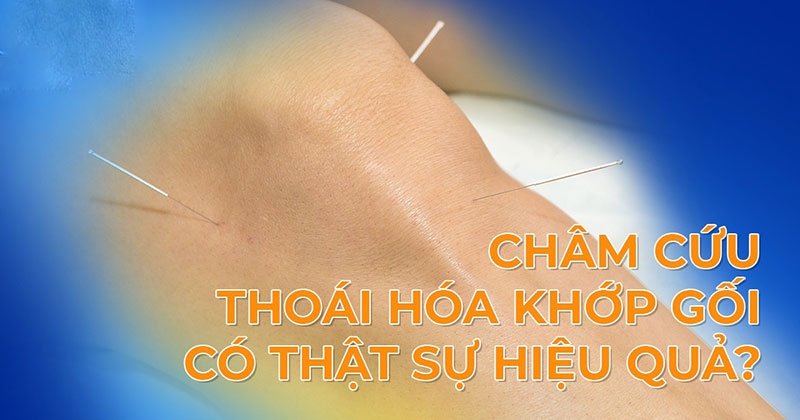 Châm cứu thoái hóa khớp gối có giúp điều trị bệnh hiệu quả không?
