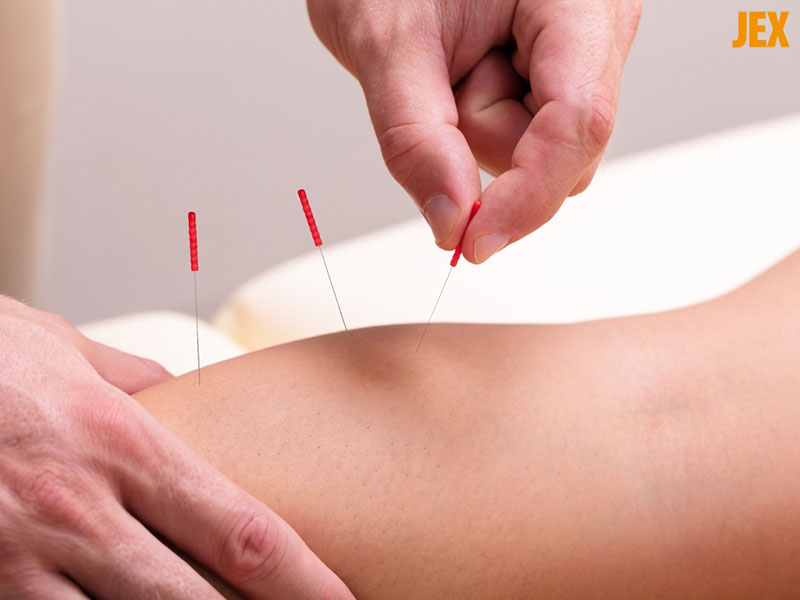 Châm cứu trị thoái hóa khớp gối