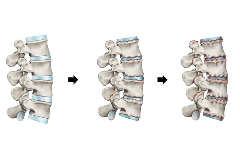 Hiện tượng viêm cột sống dính khớp