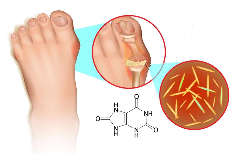 Hạt Tophi ở người bệnh gút