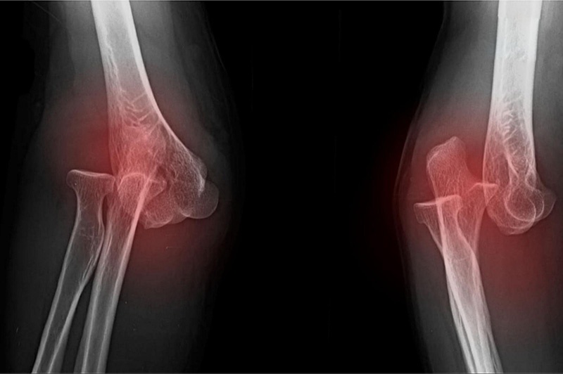 Trật khớp khuỷu tay là bị gì