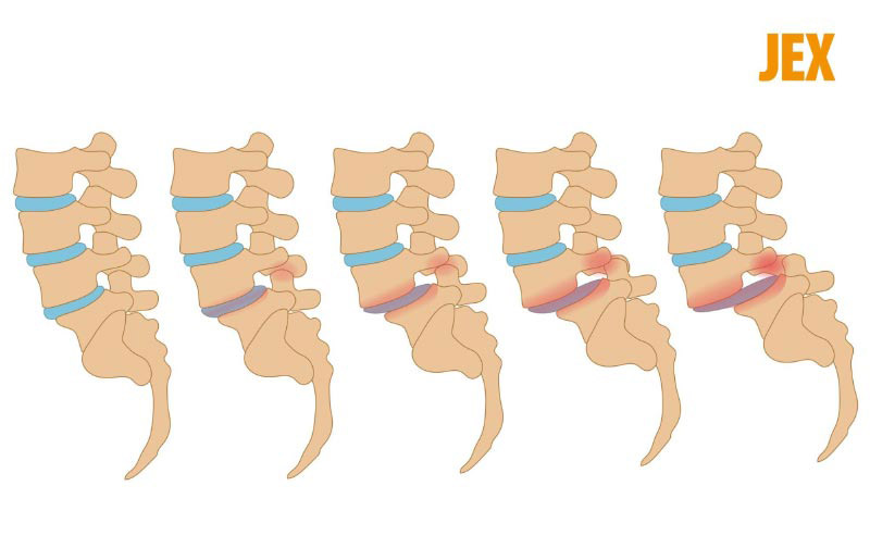 Các giai đoạn của trượt đốt sống lưng