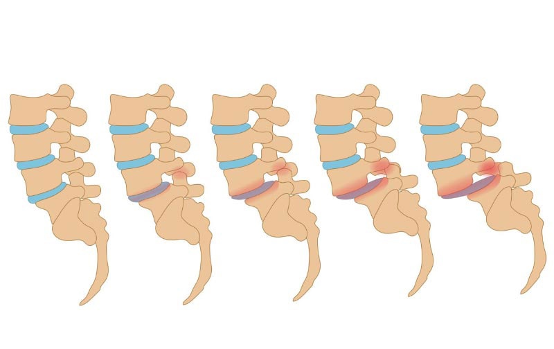 Giai đoạn của trượt đốt sống lưng
