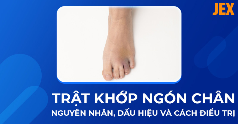 Trật khớp ngón chân: Nguyên nhân, dấu hiệu và cách điều trị