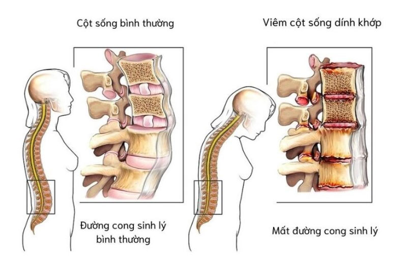 Hình ảnh viêm cột sống dính khớp