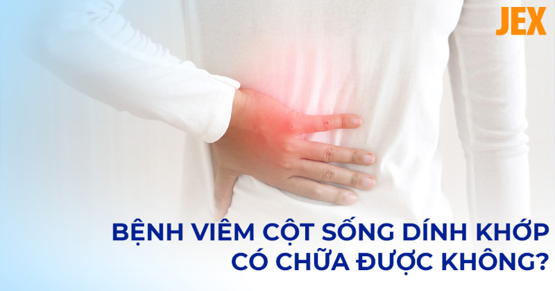 Bệnh viêm cột sống dính khớp có chữa được không? [Chuyên gia tư vấn]