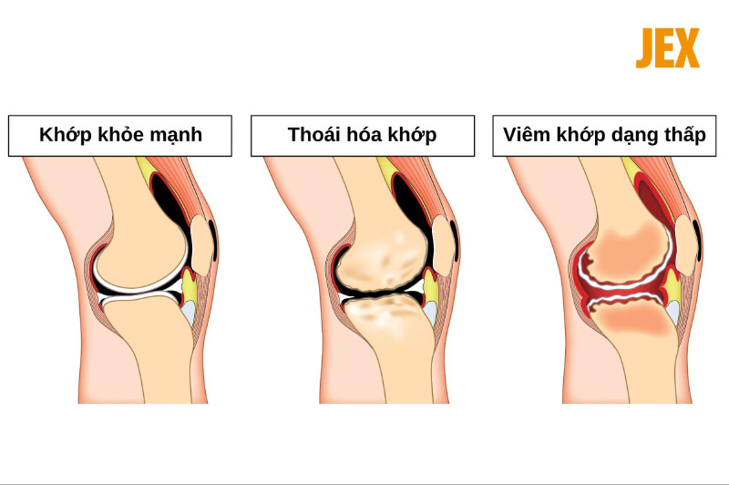 Điểm khác biệt giữa thoái hóa khớp và viêm khớp dạng thấp