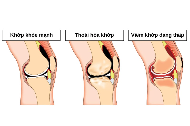So sánh thoái hóa khớp và viêm khớp dạng thấp