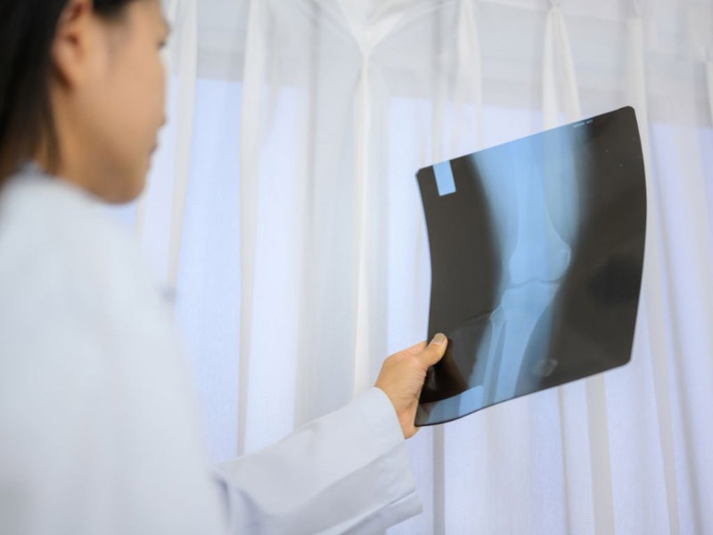 Chụp Xquang chẩn đoán giả gout