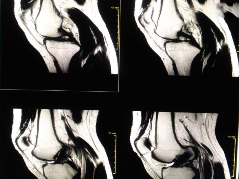 Chụp Xquang chẩn đoán tràn dịch khớp