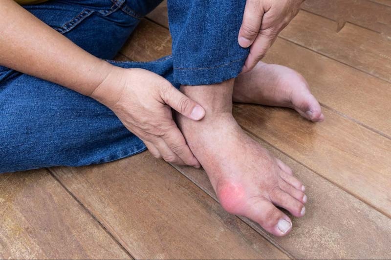 Hạt Tophi cảnh báo mắc bệnh gout
