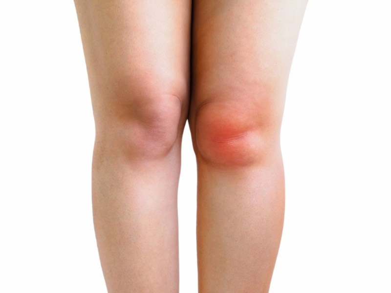 Khớp bị sưng khi tràn dịch khớp