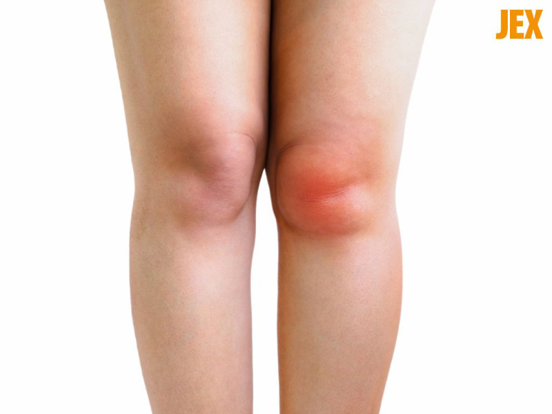 Khớp bị sưng khi tràn dịch