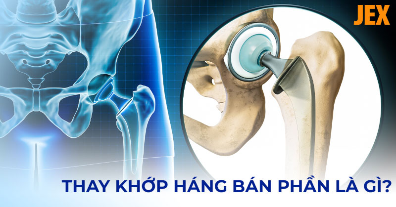 Phẫu thuật thay khớp háng bán phần là gì? Chỉ định sử dụng khi nào?