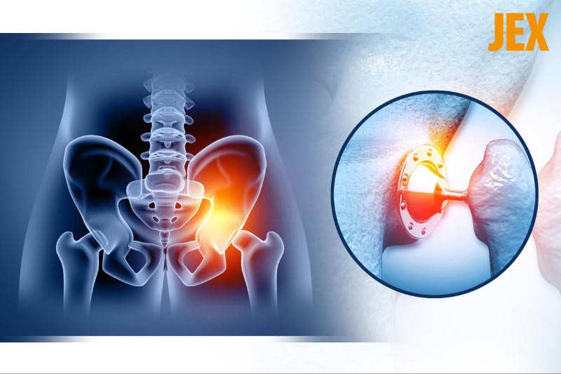 Thay khớp háng giúp khôi phục chức năng vận động