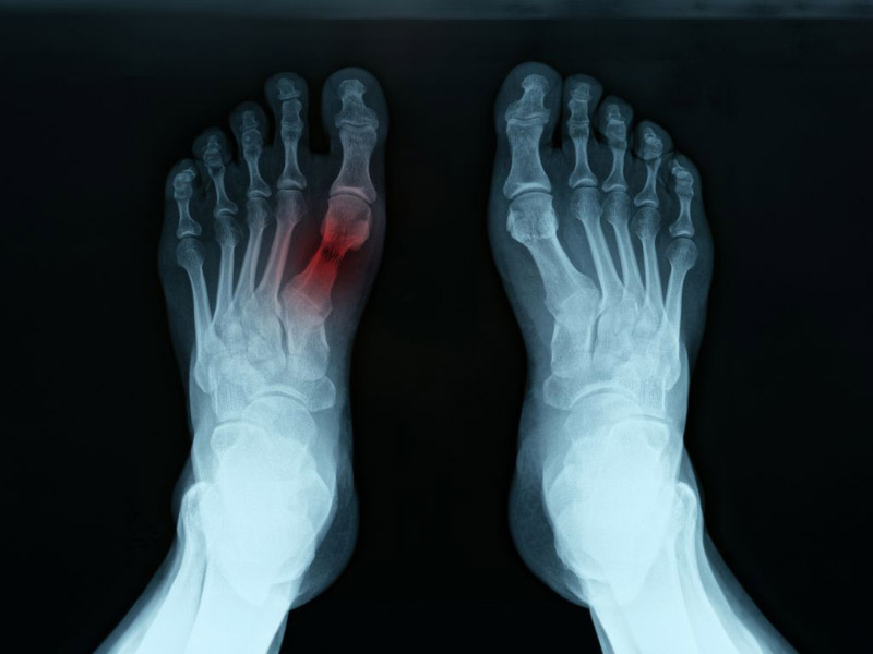 chụp xquang phát hiện viêm khớp ở ngón chân