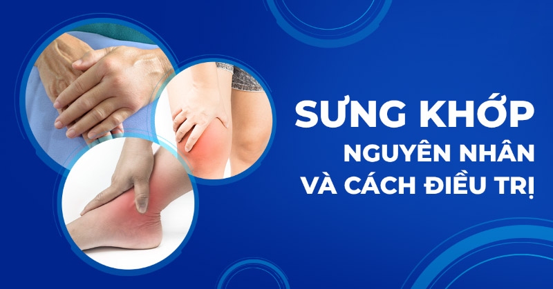 Sưng khớp là gì? Nguyên nhân, dấu hiệu, phòng ngừa và điều trị