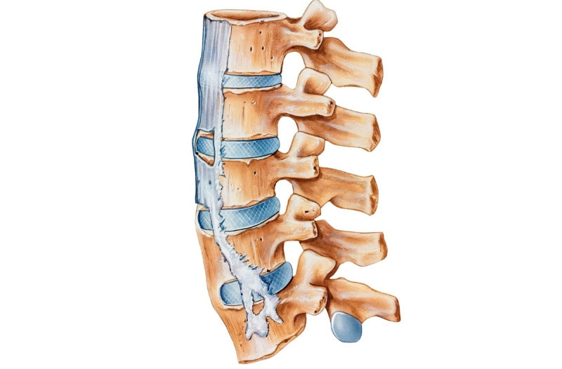 Tình trạng viêm cột sống dính khớp