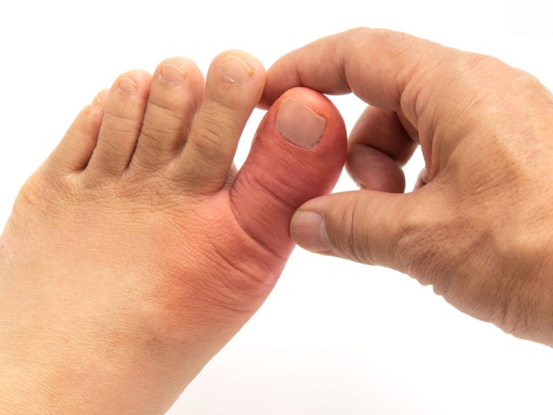 Triệu chứng sưng viêm ở ngón chân cái