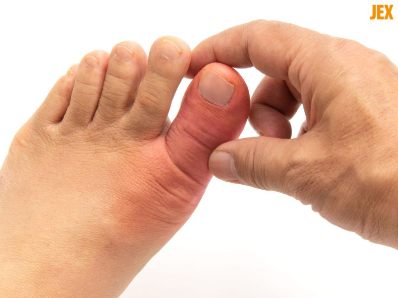 Triệu chứng viêm khớp ngón chân cái