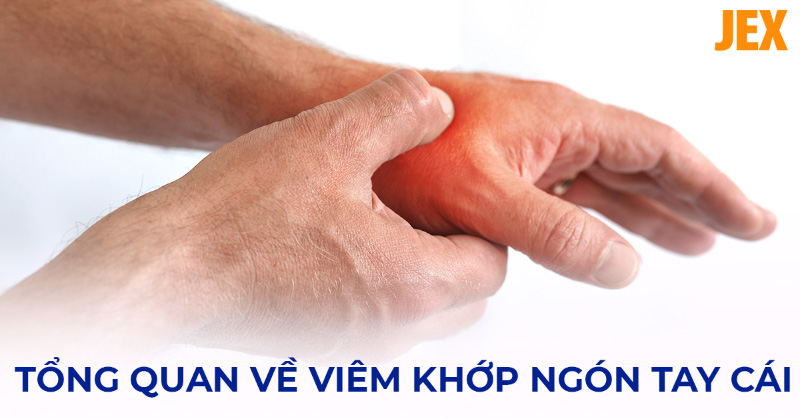 Viêm khớp ngón tay cái: Nguyên nhân, dấu hiệu và cách điều trị