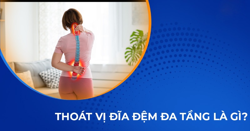 Thoát vị đĩa đệm đa tầng: Nguyên nhân, dấu hiệu và cách điều trị