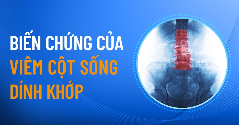 Biến chứng của viêm cột sống dính khớp