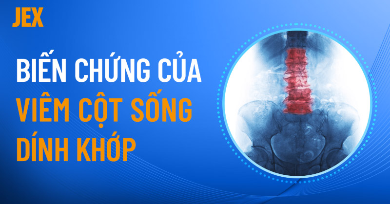 11 biến chứng của viêm cột sống dính khớp thường gặp nhất