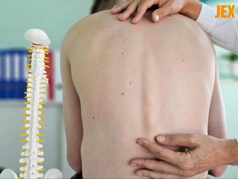 Gù lưng là biến chứng viêm cột sống dính khớp thường gặp