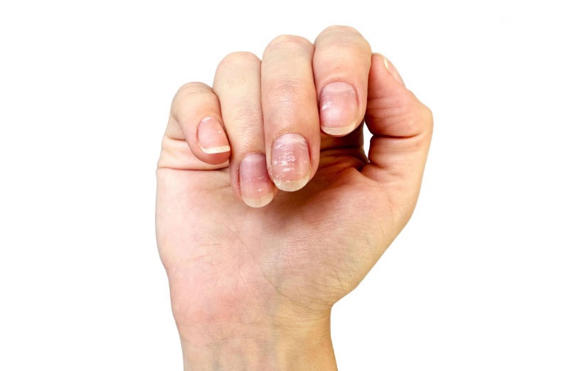 Thiếu hụt canxi khiến móng tay bị yếu