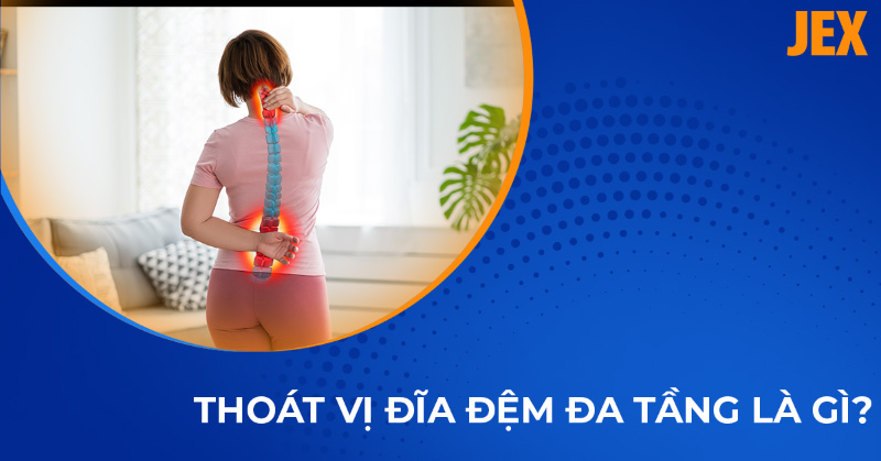 Thoát vị đĩa đệm đa tầng: Nguyên nhân, dấu hiệu và cách điều trị