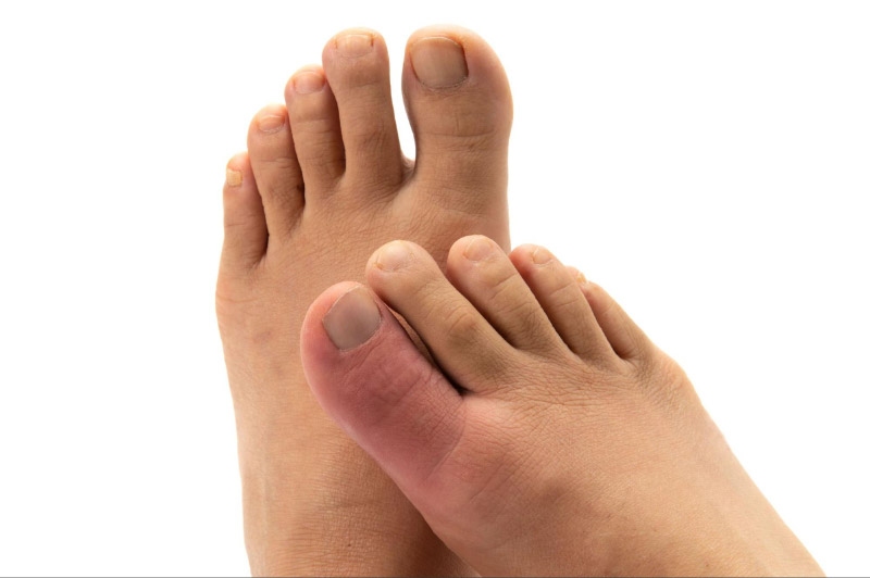 Bệnh gout có khả năng di truyền không