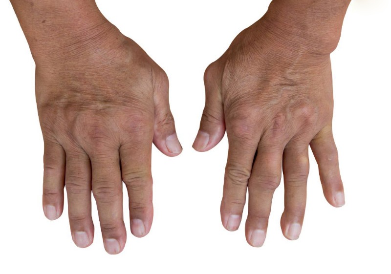 Bệnh gout ở tay