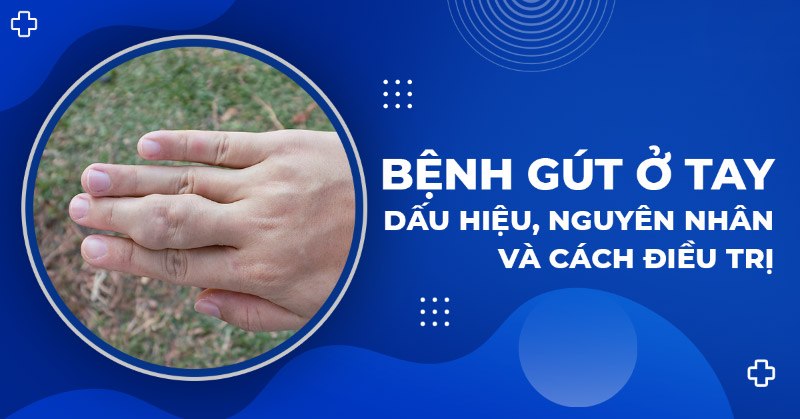 Bệnh gút ở tay: Dấu hiệu, triệu chứng và cách điều trị