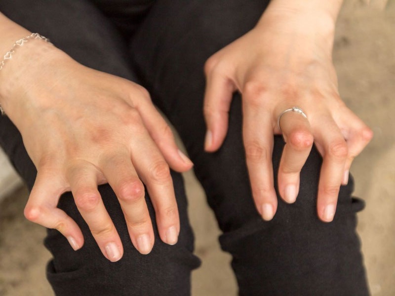 Gout gây biến dạng khớp nghiêm trọng