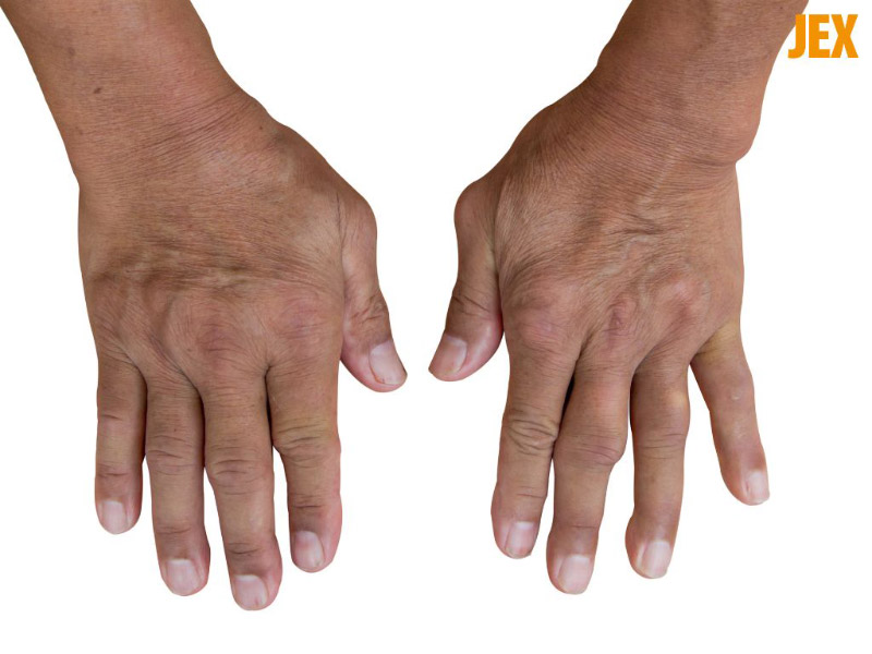 Gout ở tay