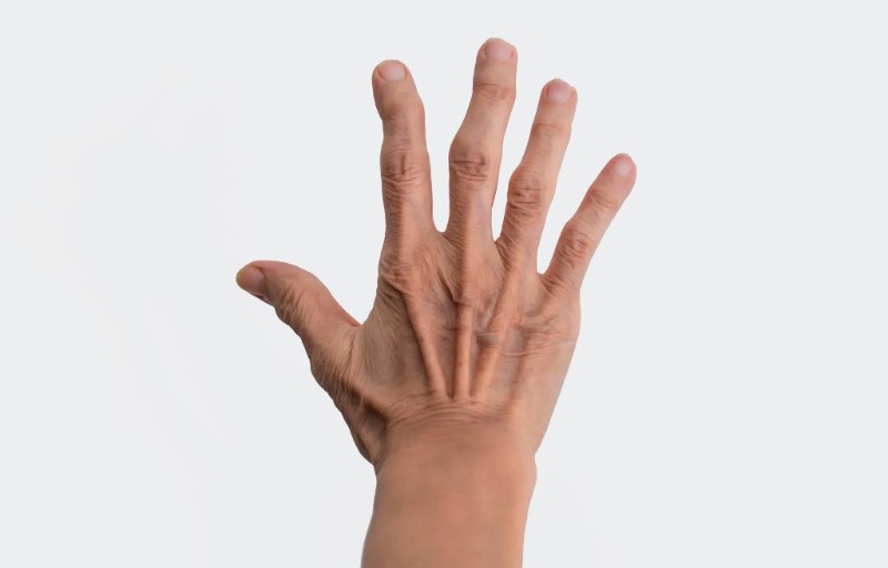 Hình ảnh bị gút ở bàn tay, ngón tay