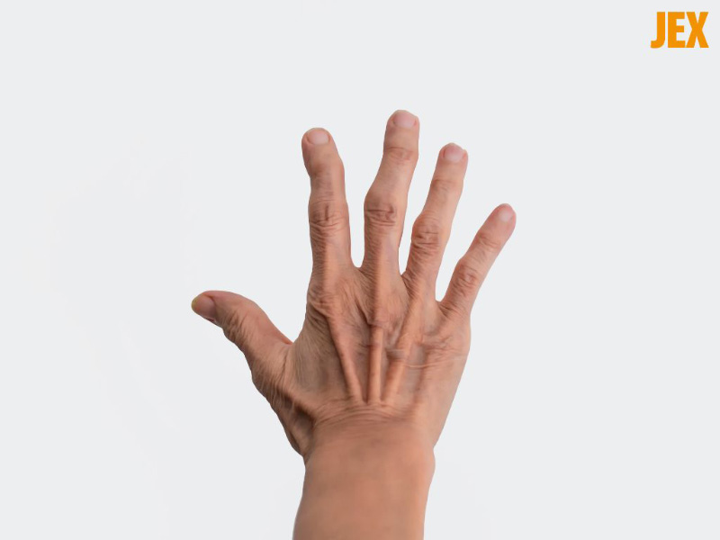 Hình ảnh gút ở bàn tay, ngó tay