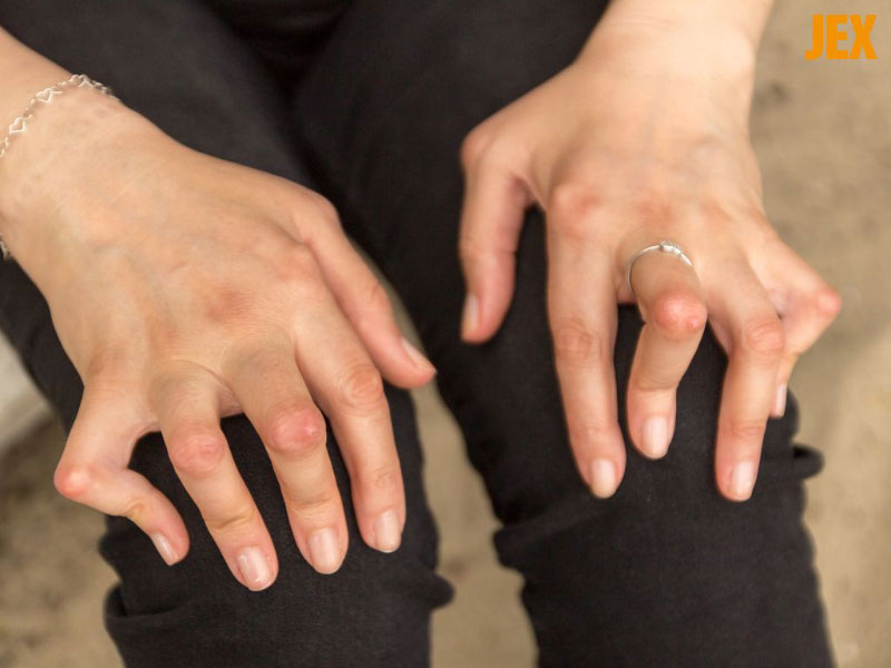 Nếu không chữa trị gout có thể gây biến dạng khớp