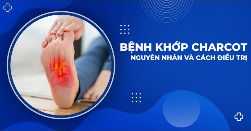 Bệnh khớp Charcot: Nguyên nhân, dấu hiệu và cách cải thiện
