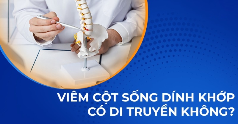 Viêm cột sống dính khớp có di truyền không? Dấu hiệu di truyền là gì?